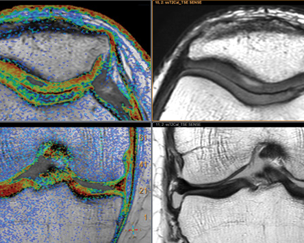 Cartilage MRI